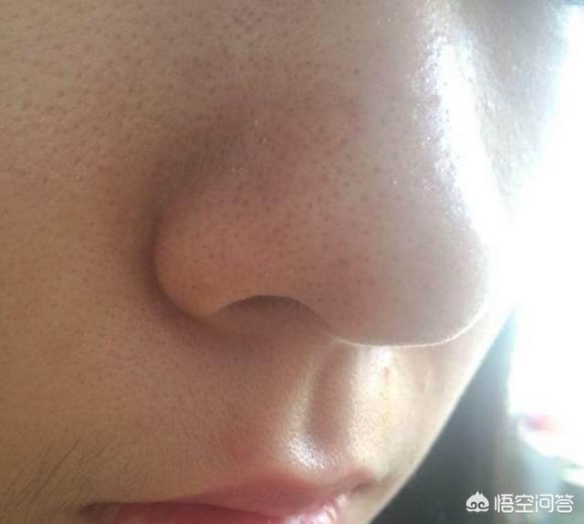 头条问答 十岁的男孩子鼻翼两侧有黑头粉刺 怎么办 翟翟说健康的回答 0赞