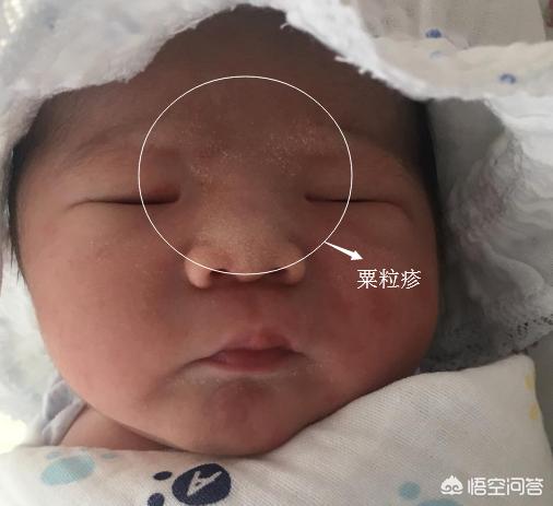 杜淳提婴儿篮:宝宝出生后有哪些异常表现不用治疗？
