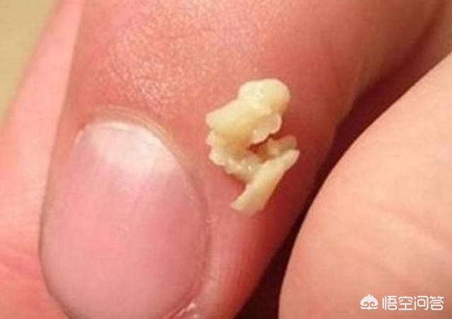 牛膝骨的意思是什么:嘴巴很臭长黄色泥是怎么了？有什么方法可以解决吗？