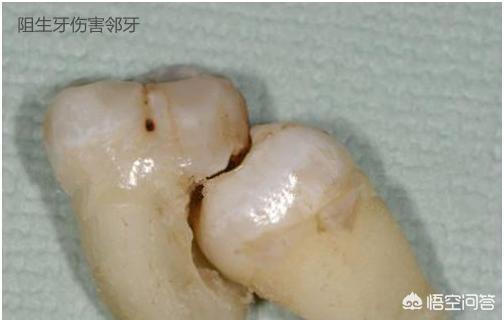 头条问答 智齿长了2个 隔段时间会痛 要不要拔 有什么利弊 29个回答