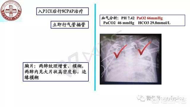 新生儿肺炎严重吗:新生儿肺炎严重吗一般要多久才好 婴儿得了肺炎，该怎么判断是什么原因引起的？