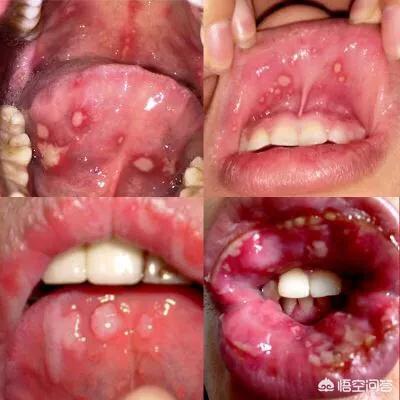 口腔溃疡吃维c管用吗维生素b2是否真的可以治疗口腔溃疡