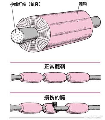 急性播散性脑脊髓炎:急性播散性脑脊髓炎能痊愈吗 脱髓鞘的具体表现是什么？