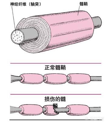 急性播散性脑脊髓炎:三岁儿童脑白质脱髓鞘有什么影响？