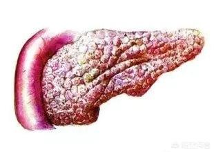 女性胰腺炎的症状是什么:胰腺炎都会疼痛吗？胰腺炎有哪些症状？