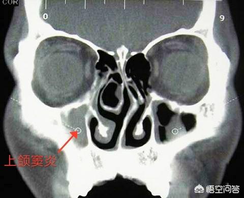 人鼻腔结构图:鼻子透光能证明是整容的吗？