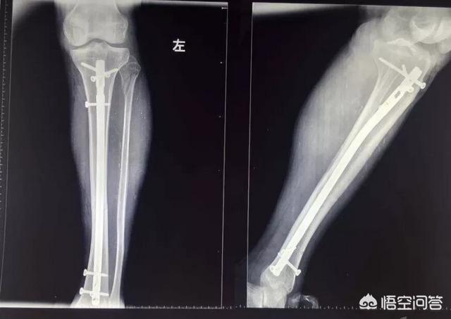 头条问答 小腿骨折手术用了一根髓内钉 请问要多长时间能下地走路 骨科副主任医师陈大乐的回答 0赞