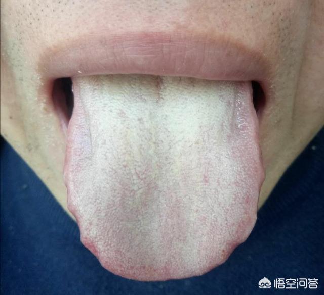 舌头胖大有齿痕，需要怎么调理？插图15