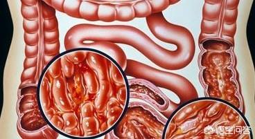 头条问答 - 溃疡结肠炎可以抽香烟吗?(4个回答)