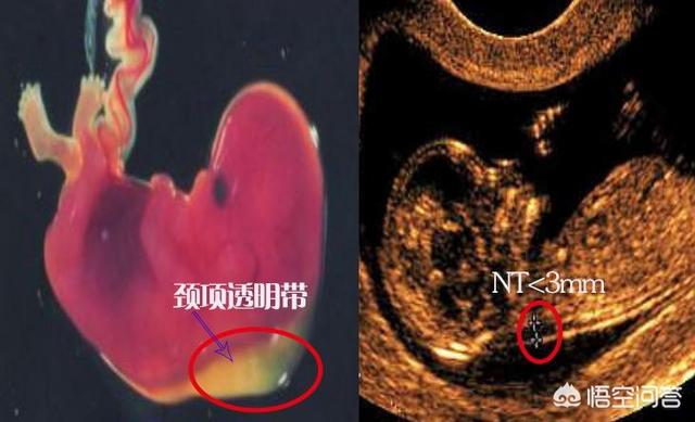 nt的正常值范围多少啊，NT值0.35mm一定代表孩子有问题吗