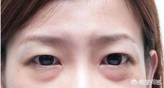 有黑眼圈、眼袋怎么办？