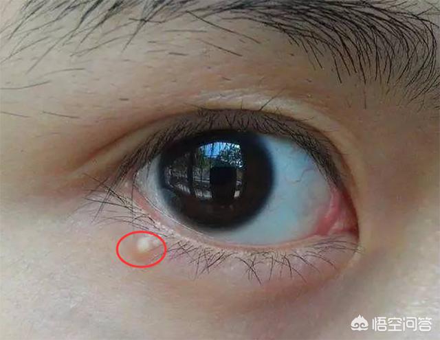 眼睛旁边的脂肪粒怎么去除眼睛周围的脂肪粒能祛除吗