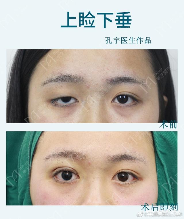 想整双眼皮发<a href=https://maguai.com/list/256-0-0.html target=_blank class=infotextkey><a href=https://maguai.com/list/256-0-0.html target=_blank class=infotextkey>朋友圈</a></a>的文案:有多少人还在犹豫到底做不做双眼皮？双眼皮该做吗？