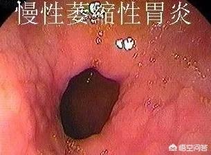 重度萎缩性胃炎的症状及治疗:萎缩性胃炎严重吗？是不是胃腔变小了？