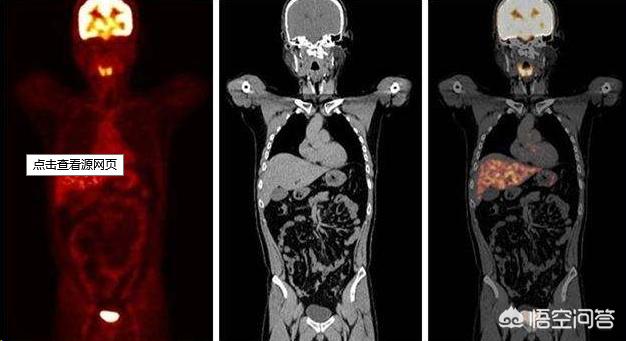 pet ct检查(petct检查癌症准确率)