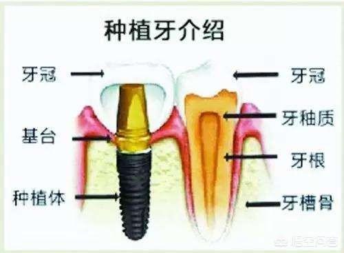 种植牙一颗大概多少钱？