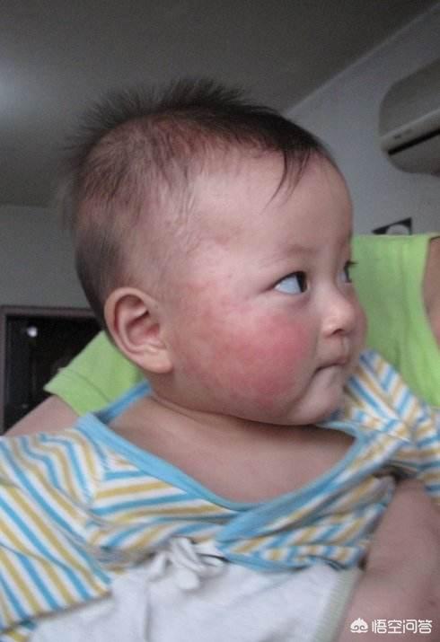 新生儿身上有红斑是怎么回事，宝宝身上有红斑是什么情况？