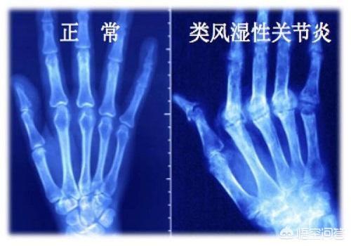 怎么增强自身免疫力抵抗类风湿性关节炎:类风湿性关节炎预防方法？