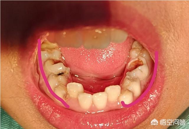 头条问答 - 蛀牙和爱吃糖有关系吗?(18个回答)