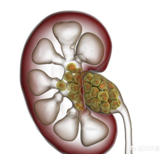 碳酸钙会不会造成肾结石和胆结石