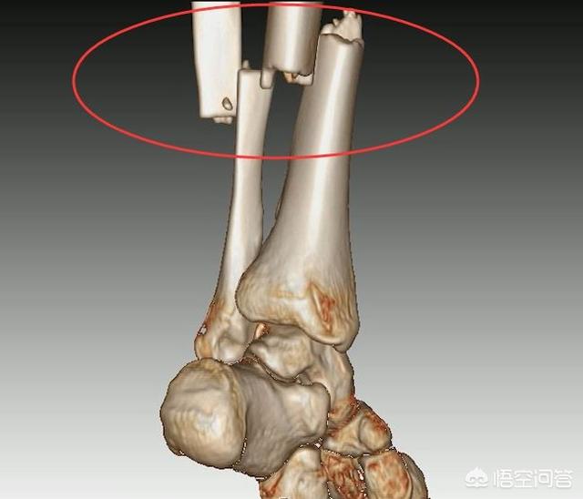 头条问答 我左胫腓骨骨折手术 已四个月了 怎么还没有长骨咖 有什么办法没有 雷霆万钧123的回答 0赞