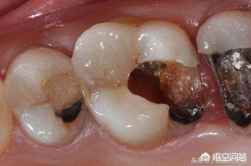 牙髓炎化脓图片