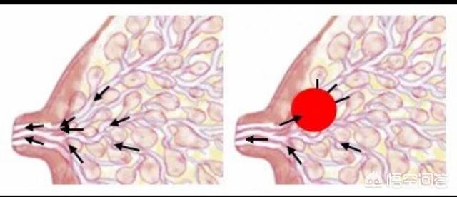 急性乳腺炎吃什么药止痛:急性乳腺炎，该怎么缓解？