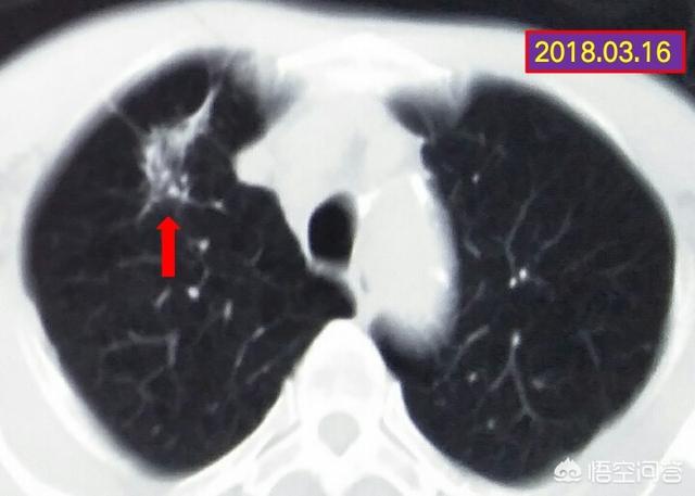 莱姆病症状有什么:莱姆病的症状 耳石症是什么，它有哪些症状？