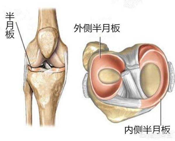 半月板损伤症状:双腿半月板损伤，现在一走路就裂开痛，且有声响，怎么办？