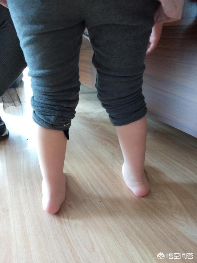 六个月的宝宝去医院检查时说缺钙且足外翻因缺钙引起的足外翻需要穿