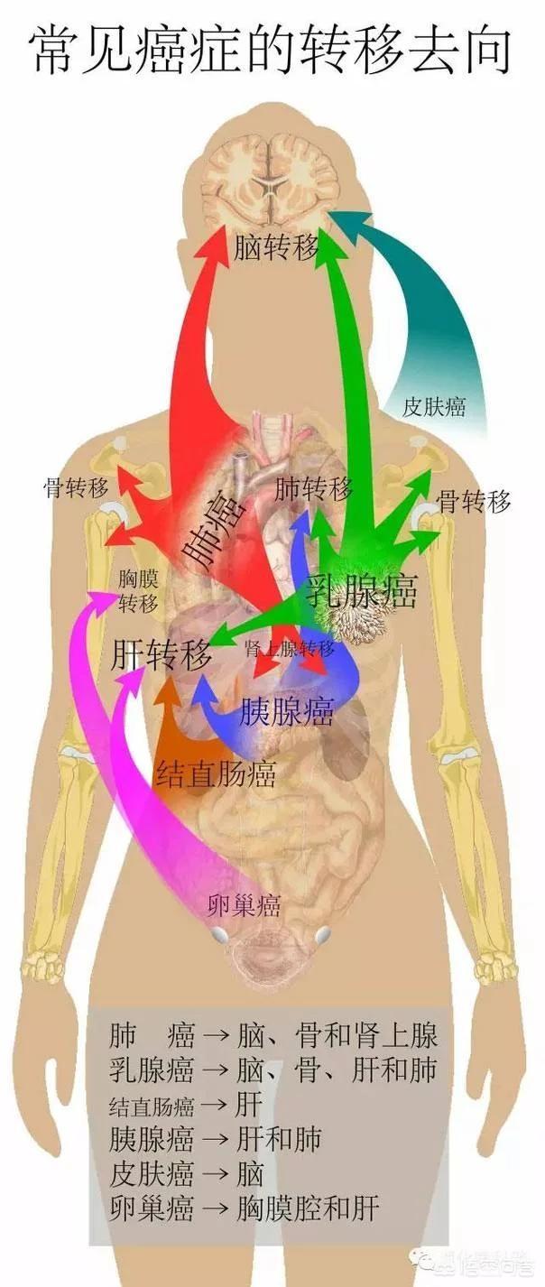 莱姆病症状有什么:抗莱姆病有什么真症状 癌细胞转移患者会出现哪些症状？有没有办法控制转移？