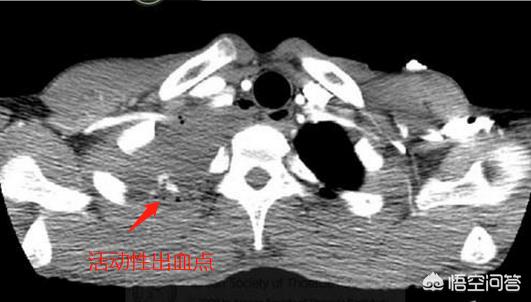 头条问答 气胸是怎么回事 23个回答