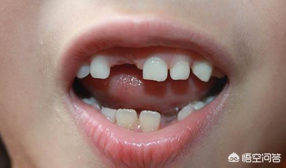 乳牙松动这种是正常的,说明恒牙要萌出了,让它自动脱落就可以.