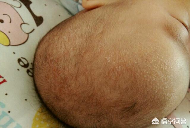 杜淳提婴儿篮:宝宝出生后有哪些异常表现不用治疗？