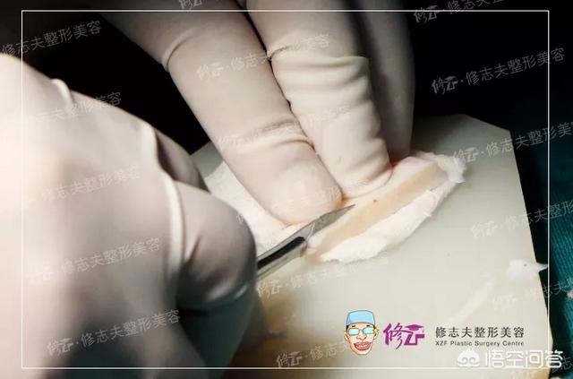 鼻综合手术拆线多少钱:鼻综合诊所拆线大概多少钱 鼻部整形中隆鼻和鼻综合整形具体有什么区别？