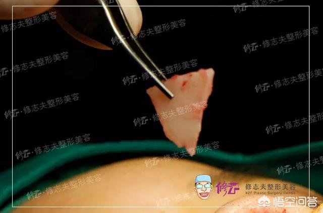 鼻综合手术拆线多少钱:鼻综合诊所拆线大概多少钱 鼻部整形中隆鼻和鼻综合整形具体有什么区别？