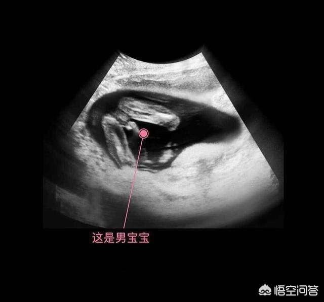 头条问答 是不是男宝宝胎动会多一点 有何科学依据 17个回答