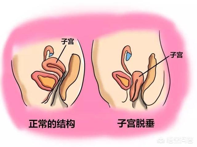 怎样能用手摸到子宫口怀孕时子宫被撑大产后应如何促进子宫恢复