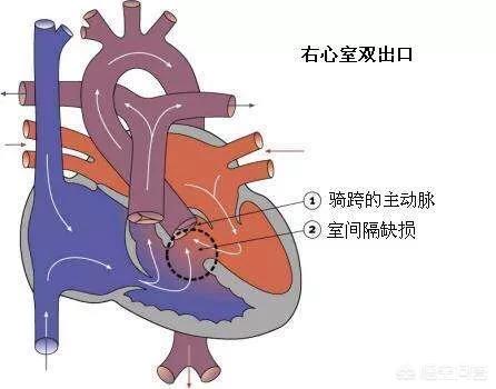 肺动脉高压能活多久(先天性心脏病引起肺动脉高压能活多久)
