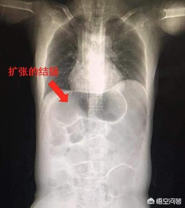 巨结肠都是多大发现的:巨结肠是什么病，严重吗？