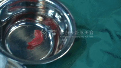 鼻综合手术拆线多少钱:鼻综合诊所拆线大概多少钱 鼻部整形中隆鼻和鼻综合整形具体有什么区别？