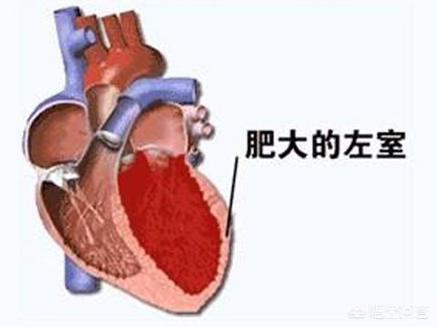 肥厚型心肌病发病率高吗:哪些是肥厚性心肌病的易发病人群？