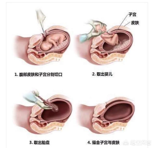 剖腹产和顺产的差别在哪?-头条问答