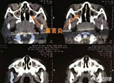 紧张性头痛怎么办(紧张性头痛怎么治疗效果更佳)