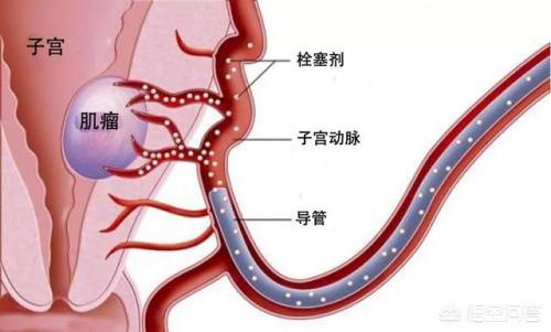 血管畸形介入手术后颈部有肿块:做完介入手术后一个月又怀孕孩子可以要吗？