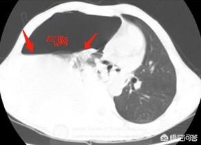 头条问答 气胸是怎么回事 23个回答