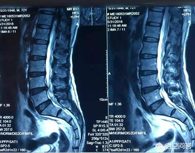 腰椎间盘突出症久坐腰痛直不起来,还可以和腰椎的关节突关节相关,长期