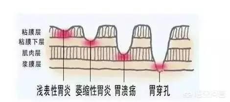 浅表性胃炎的症状及治疗:浅表性胃炎有哪些症状？治疗期间应该如何调理？