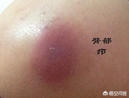 消炎药是抗生素吗:为什么有些人把抗生素当成消炎药来使用？