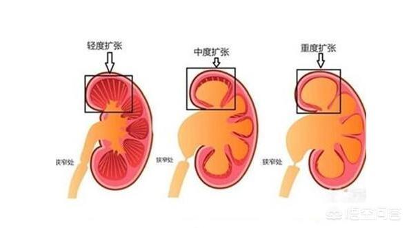 胎儿肾积水怎么办(7个月胎儿积水有什么影响吗)